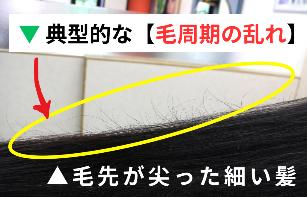 典型的な「毛周期の乱れ」特徴として「毛先が尖った細い髪」が髪の表面に沢山ある写真