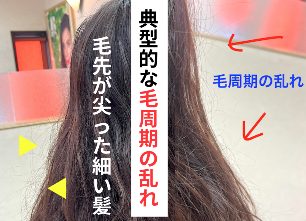 毛先が尖った細い髪が沢山ある【毛周期の乱れ】が現れている典型的な写真